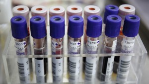 Una empresa de EE.UU. busca ganarle la carrera al cáncer con pruebas rápidas de ADN