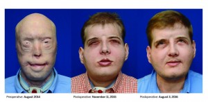 Hombre con trasplante de rostro CDN37