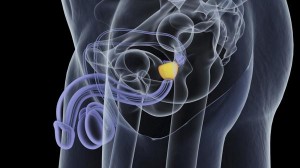 Nuevo estudio asegura que no hay diferencias significativas entre tratar o no el cáncer de próstata durante su etapa inicial