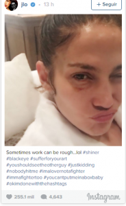 Jennifer López publica una foto con el ojo morado