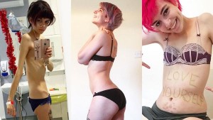 Una joven muestra en fotos cómo se recupera de la anorexia: 