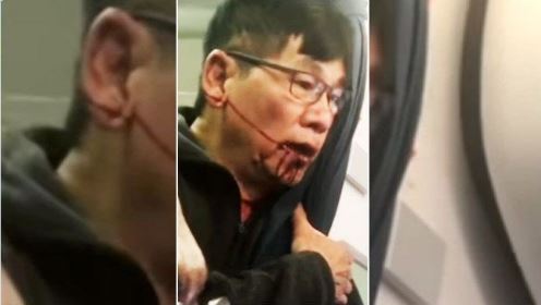 Pasajero que fue expulsado violentamente del avión de United necesita cirugía plástica