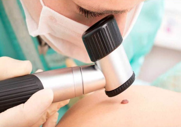 Desarrollan nueva técnica para la detección precoz del melanoma
