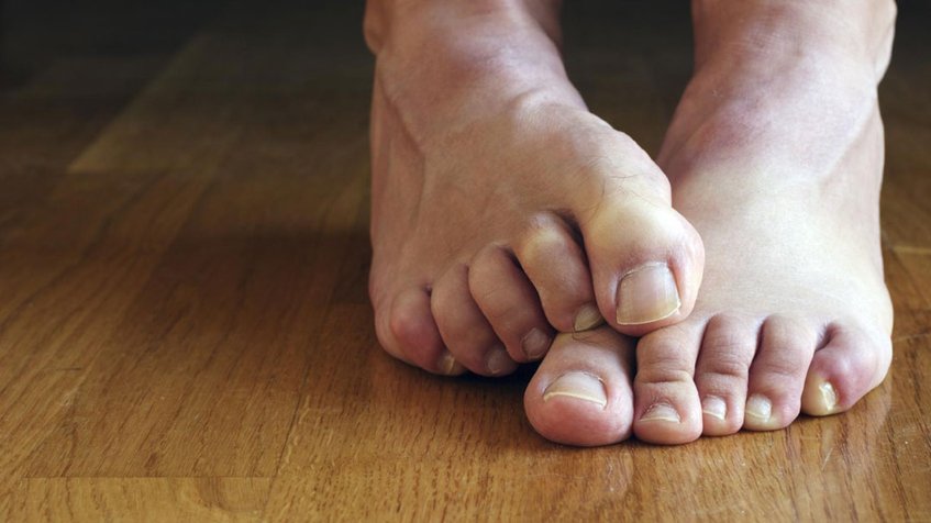 ¿Conoces las causas del pie de atleta?