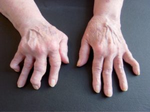 Tratamiento de artritis reumatoide es muy costoso y no lo cubre Seguridad Social