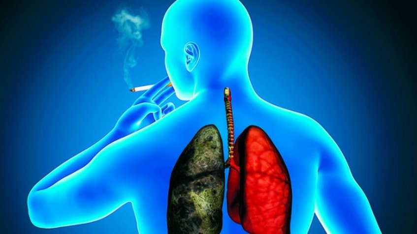 El 25% de los casos de cáncer de pulmón desarrollan metástasis cerebral