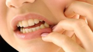 Conozca los mitos y realidades de la gingivitis 