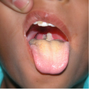 La difteria puede llegar a matar a uno de cada cinco niños contagiados