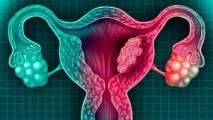 En 2019, RD registró 560 muertes por cáncer cervico uterino