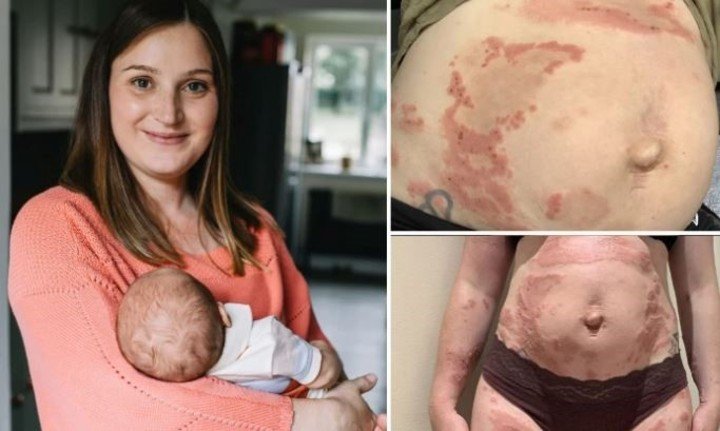 Fiona Hooker; mujer europea que es alérgica a su propio hijo