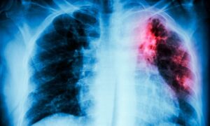 548 dominicanos han sido diagnosticados con tuberculosis en 2022