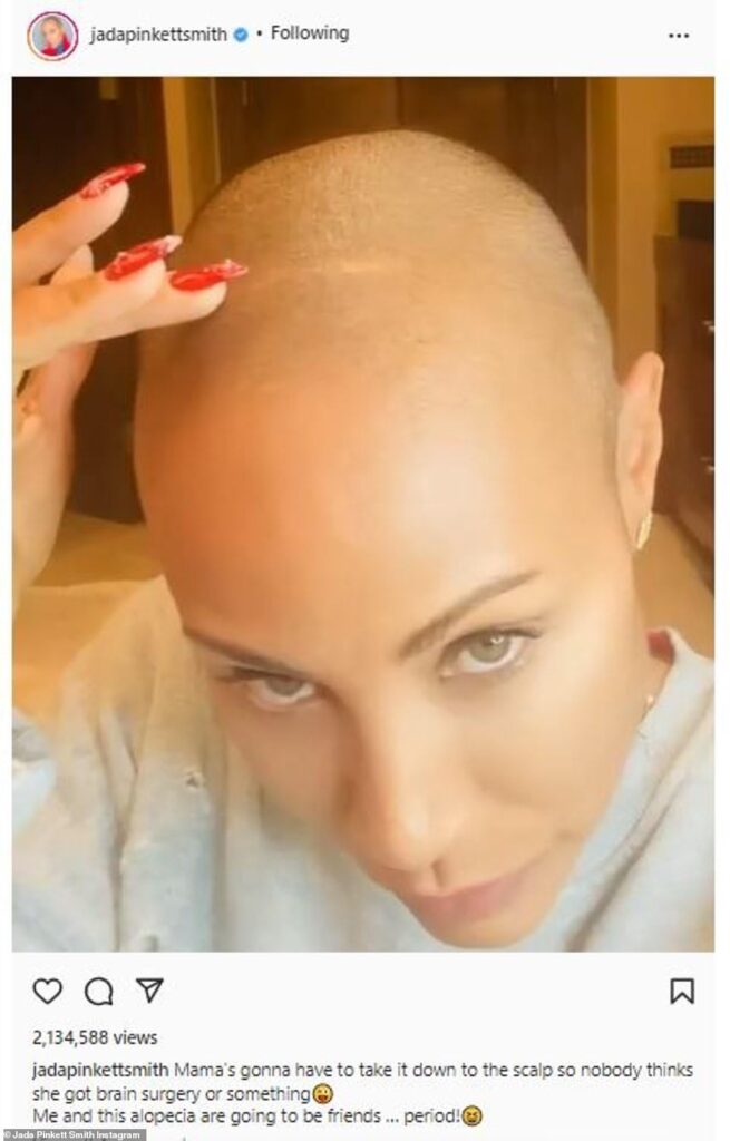 Alopecia: ¿cómo es la enfermedad de la esposa de Will Smith?