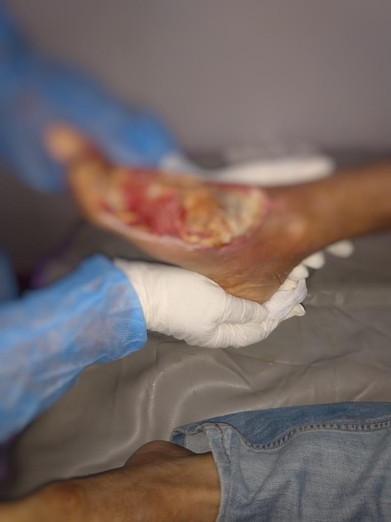 Interno Raymundo Ureña. Centro de Corrección y Rehabilitación San Francisco de Macorís. Paciente diabético. Se le amputó el primer dedo del pie derecho.