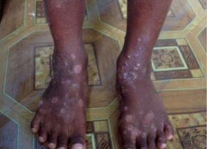 Haití detecta infección altamente contagiosa por contacto de la piel