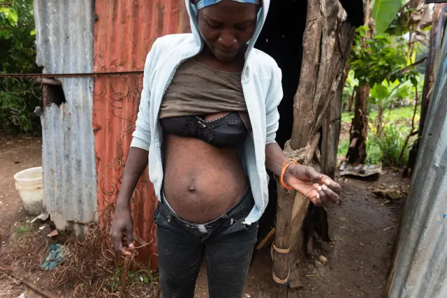 Sarcoptosis: Así se llama y se ve la "sarna" que azota a Haití 