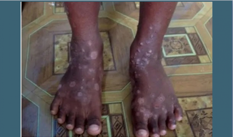 Llaman a no alarmarse por infección similar a sarna detectada en Haití