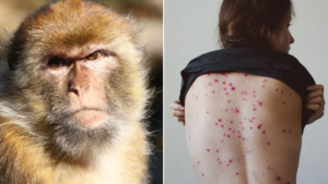 Perú se declaró en alerta por la viruela del mono que se detectó en Estados Unidos y Europa