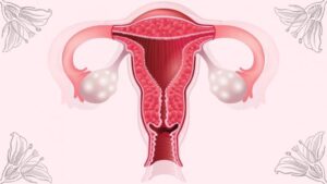 Medicos recomienda visitar al ginecologo periodicamente y hacerse un papanicolau cada año, para detectar a tiempo el cáncer de ovarios
